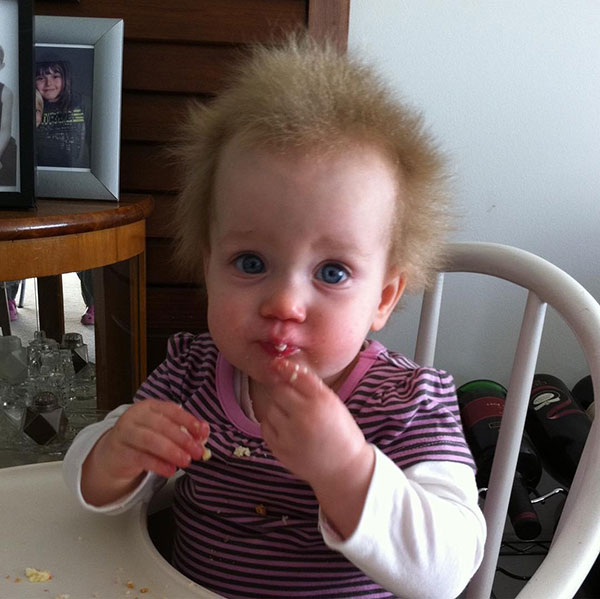 หนูน้อย 7 ขวบ ป่วยโรคแปลก ผมหวีไม่ได้ แต่กลายเป็นเก๋ไปอีกแบบ