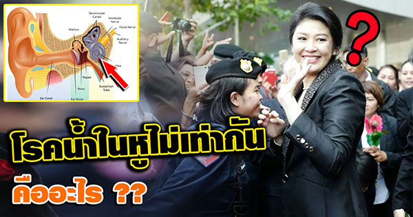 โรคน้ำในหูไม่เท่ากัน อาการเป็นเช่นไร