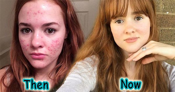 วิธีรักษาสิว