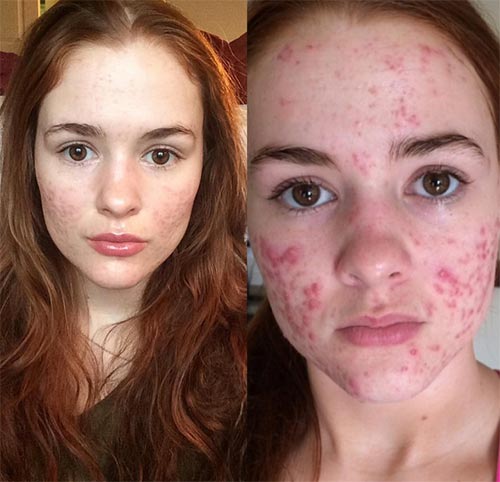 วิธีรักษาสิว