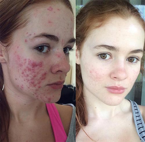 วิธีรักษาสิว