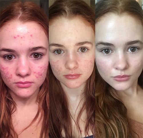 วิธีรักษาสิว