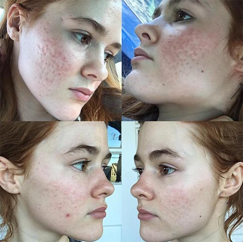 วิธีรักษาสิว