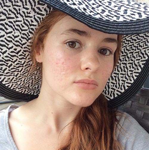 วิธีรักษาสิว