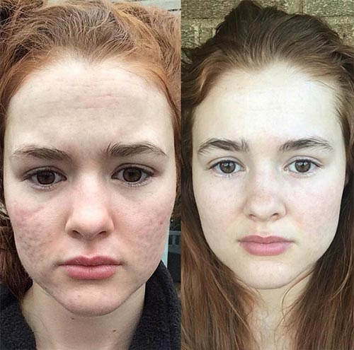 วิธีรักษาสิว