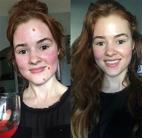 วิธีรักษาสิว