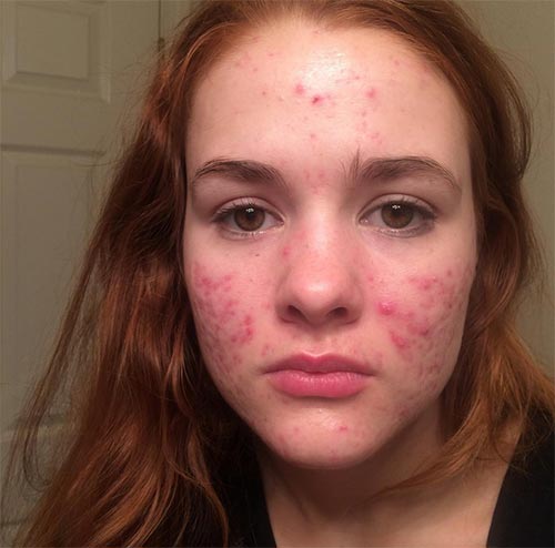 วิธีรักษาสิว