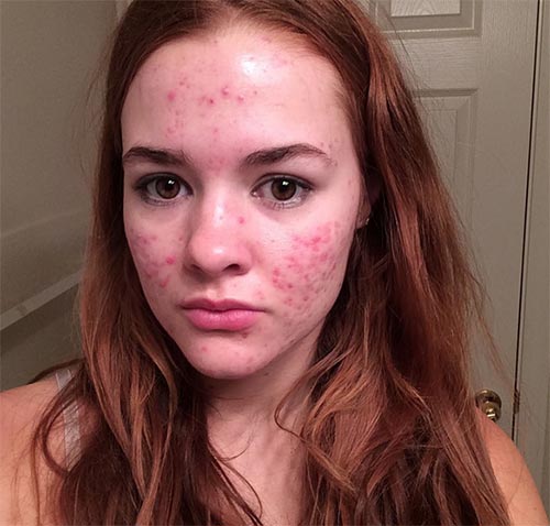 วิธีรักษาสิว