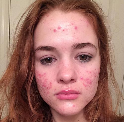 วิธีรักษาสิว