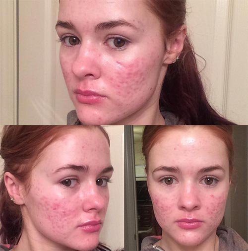 วิธีรักษาสิว