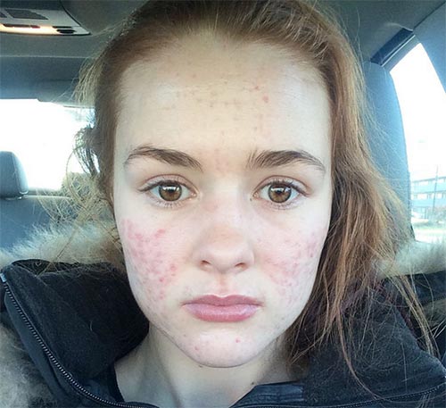 วิธีรักษาสิว