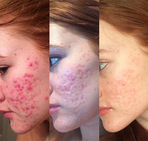 วิธีรักษาสิว