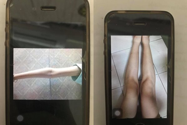 โรคคลั่งผอม