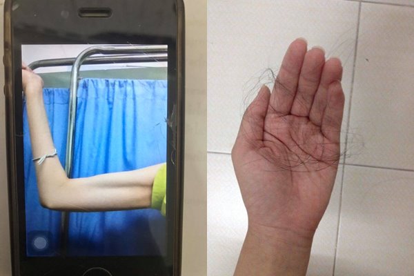 โรคคลั่งผอม