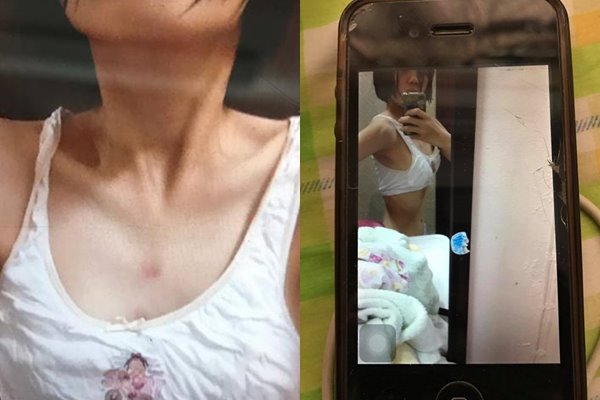 โรคคลั่งผอม