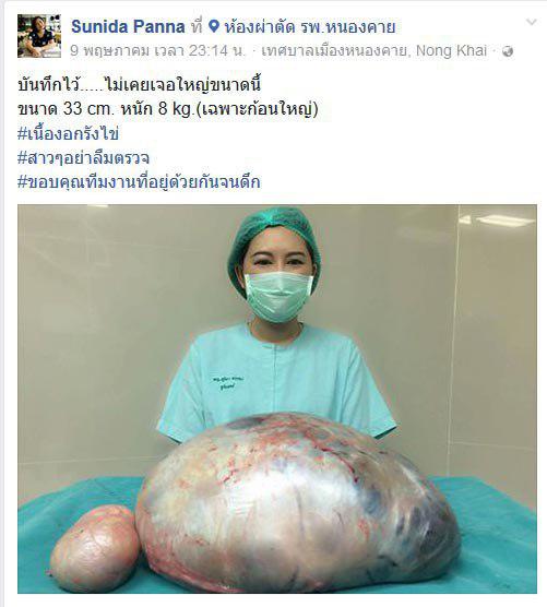  เนื้องอกรังไข่