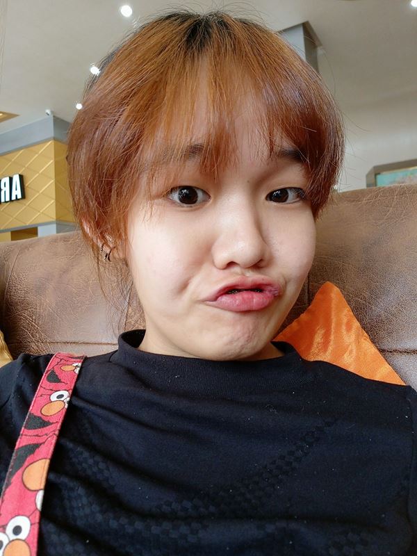  น้องคิตตี้ ศัลยกรรม