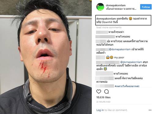 โดม หวิดเสียโฉมเกือบหมดหล่อ