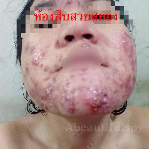 สาวระทม สั่งครีมหน้าเด้งในเน็ตมาใช้