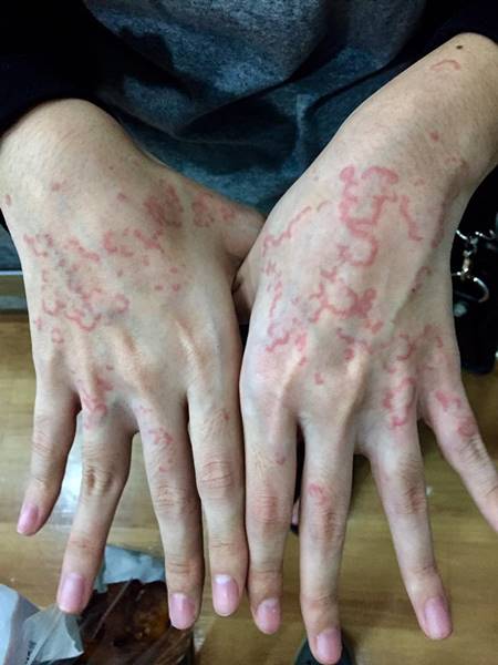 สาวกินส้มตำกุ้งสดจนอาหารเป็นพิษ