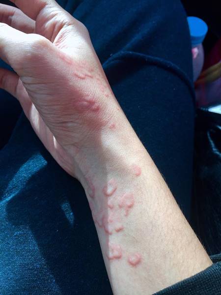 สาวกินส้มตำกุ้งสดจนอาหารเป็นพิษ