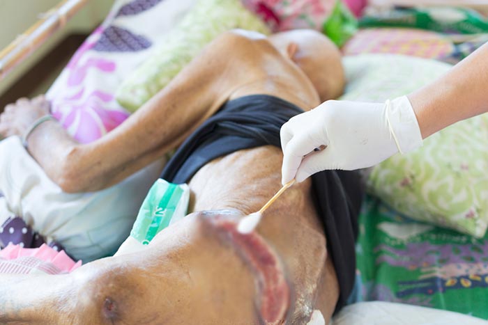 แผลกดทับ