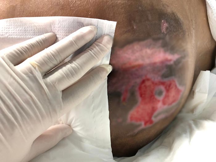 แผลกดทับ