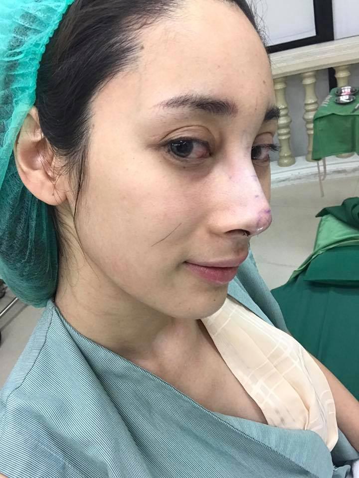 น้ำเพชร ฏีญาร์ภา ศัลยกรรม