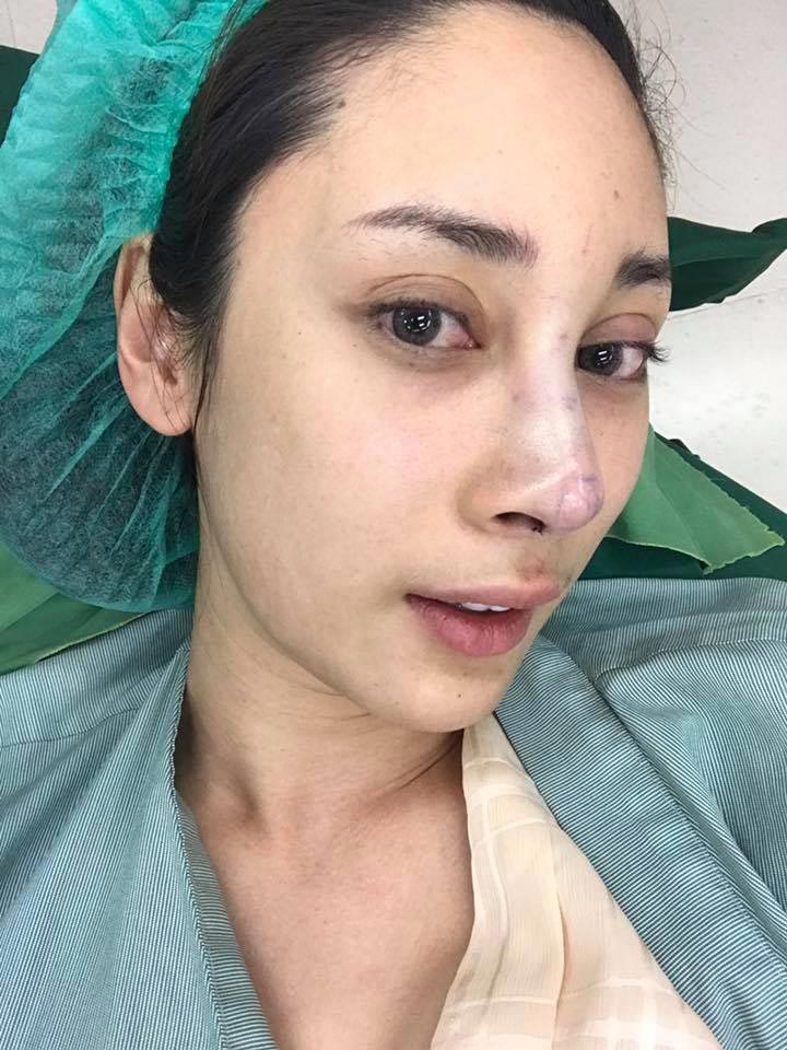 น้ำเพชร ฏีญาร์ภา ศัลยกรรม