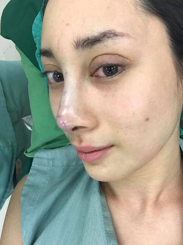 น้ำเพชร ฏีญาร์ภา ศัลยกรรม