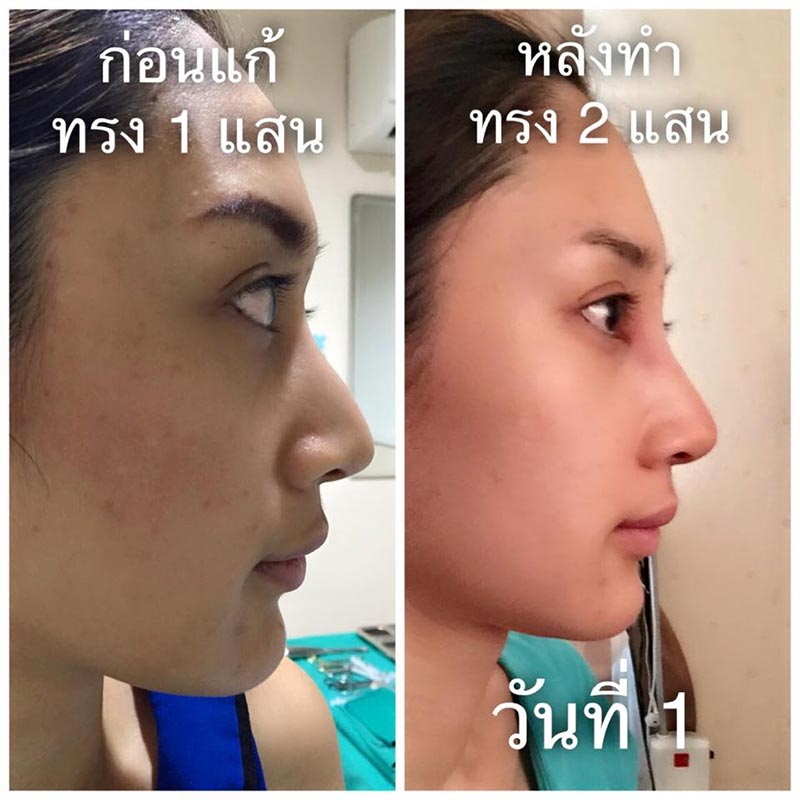 น้ำเพชร ฏีญาร์ภา ศัลยกรรม