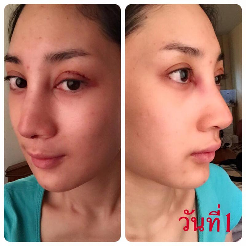 น้ำเพชร ฏีญาร์ภา ศัลยกรรม