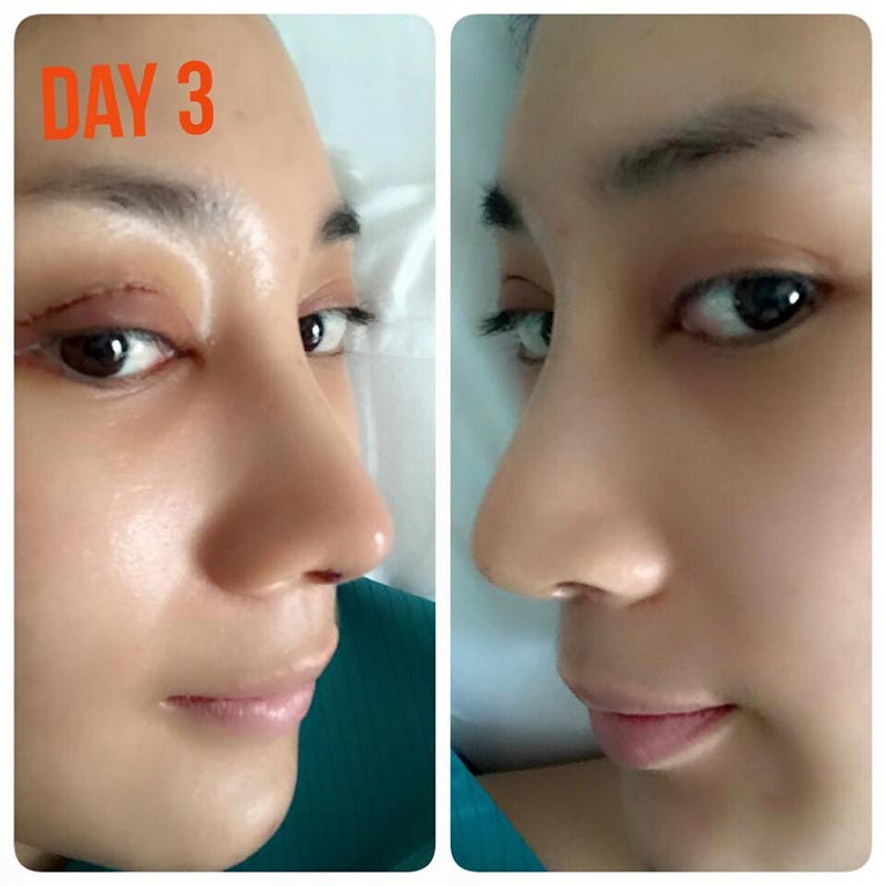 น้ำเพชร ฏีญาร์ภา ศัลยกรรม