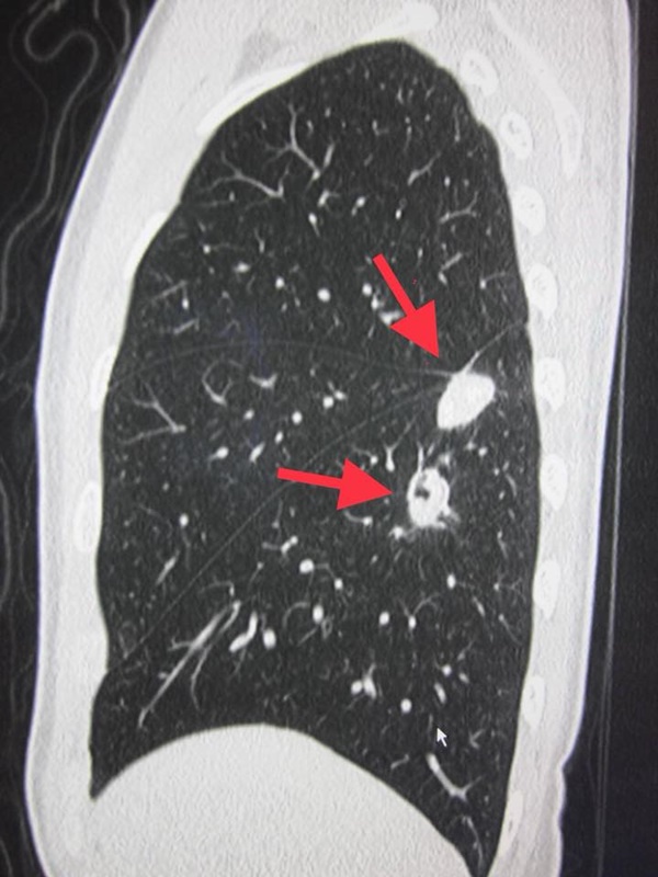 ติดเชื้อสปอร์เห็ด