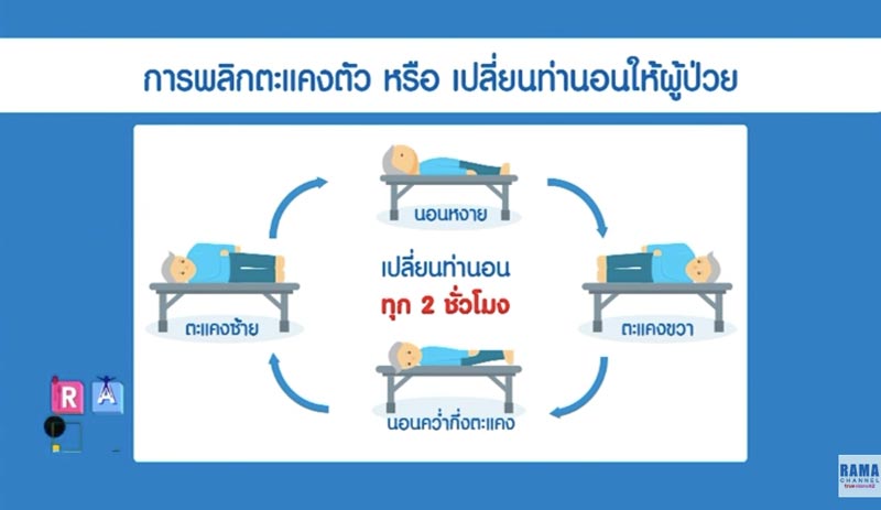 วิธีทำแผลกดทับ