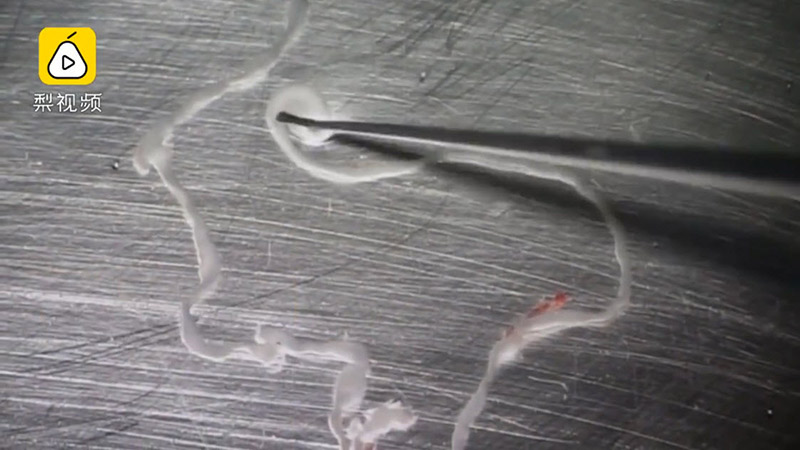 พยาธิในสมอง