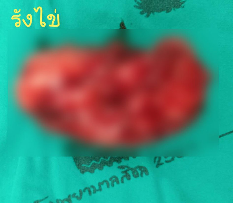 หนองในรังไข่