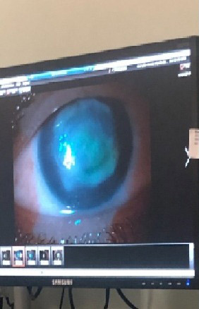 ใส่คอนแทคเลนส์ว่ายน้ำ