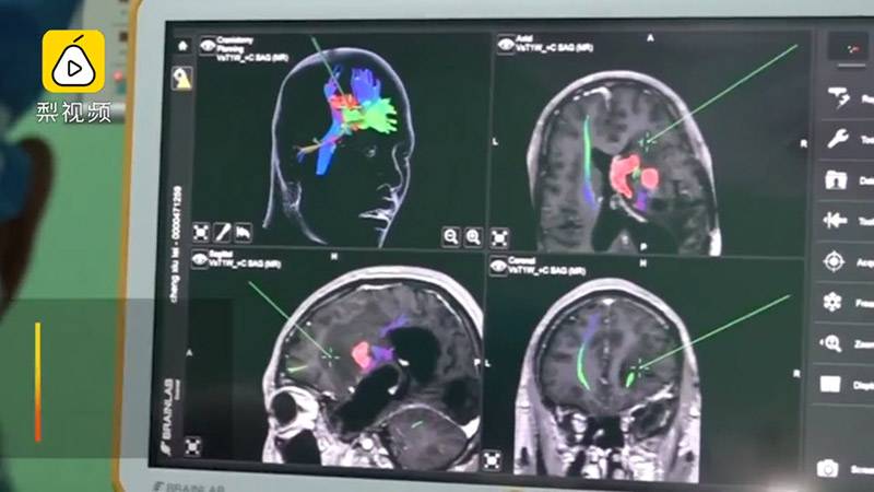 พยาธิในสมอง