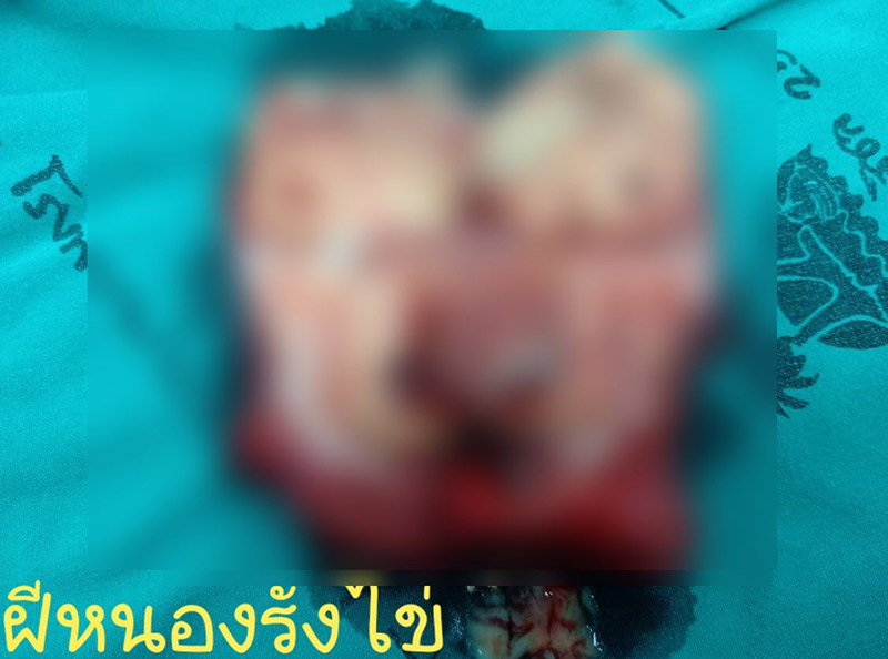 หนองในรังไข่