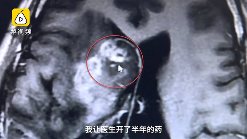 พยาธิในสมอง