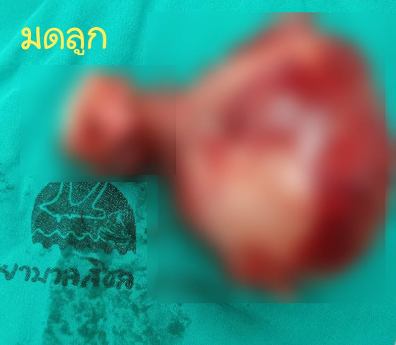 หนองในรังไข่