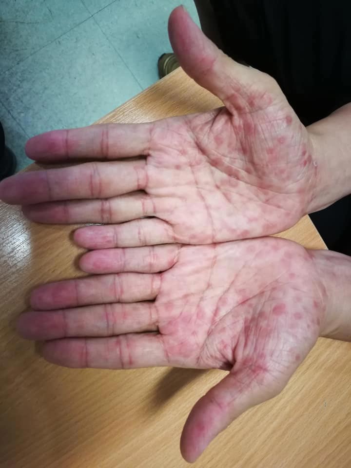 โรคซิฟิลิส