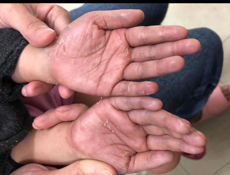 โรคซิฟิลิส