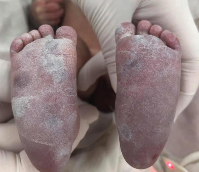 โรคซิฟิลิส