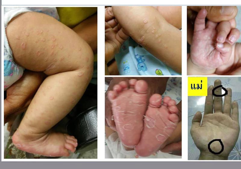 โรคซิฟิลิส