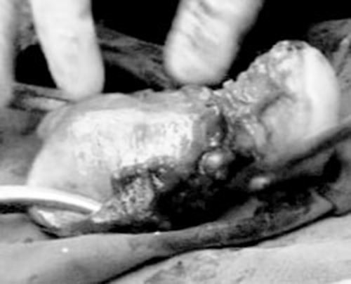 ปวดท้อง