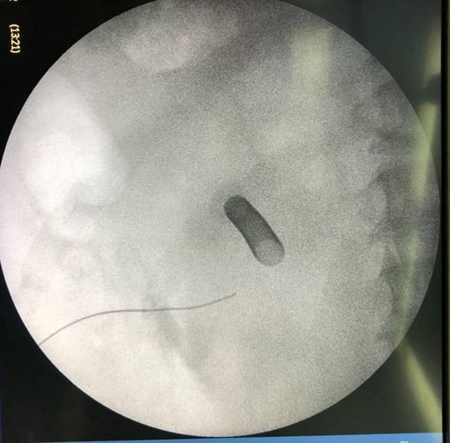 นิ่วในไต