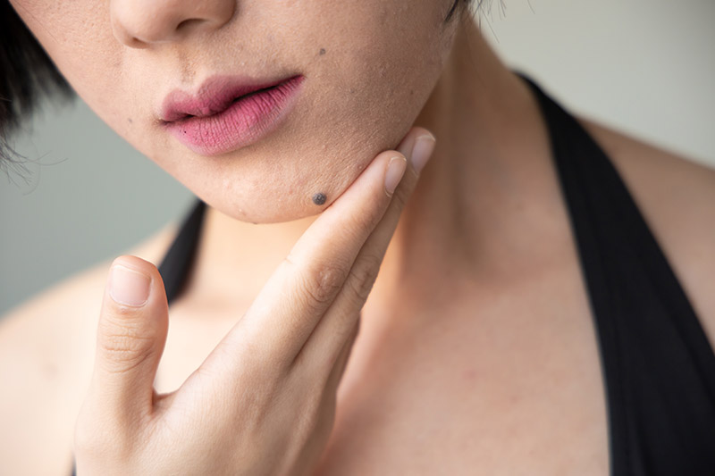 ดูดวงไฝบนหน้า