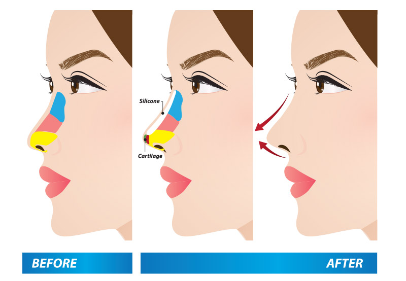 เสริมจมูก